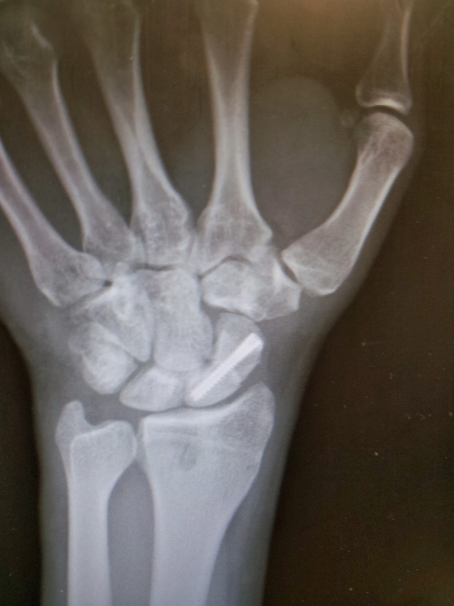 Damnnn kid, is that titanium!